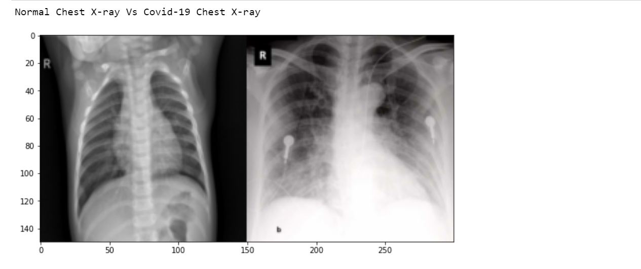 X-rays normal vs covid-19